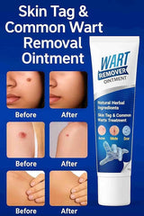 New Wart Remover Ointment cream PACK OF 2